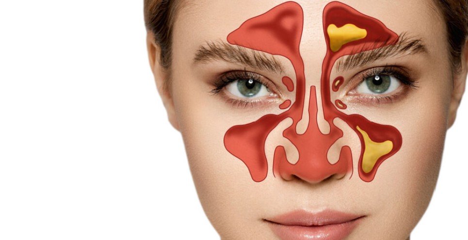 Seno paranasale infiammato: sintomi e cause
