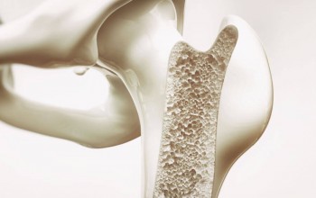 Osteoporosi: sintomi e trattamento
