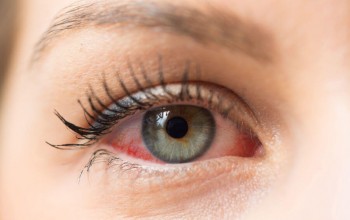 Le cause e rimedi alla sindrome dell'occhio secco