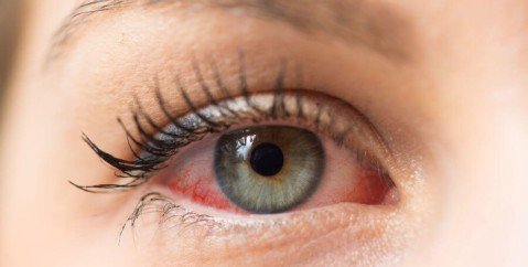 Le cause e rimedi alla sindrome dell'occhio secco