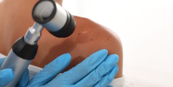 Mappatura dei nei a Roma: perché l’epiluminescenza può salvarti la pelle