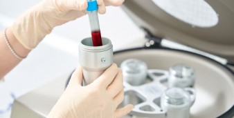 Piastrine alte o basse: cosa indicano gli esami