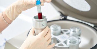 Piastrine alte o basse: cosa indicano gli esami