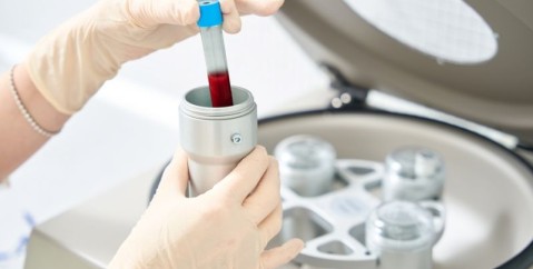 Piastrine alte o basse: cosa indicano gli esami